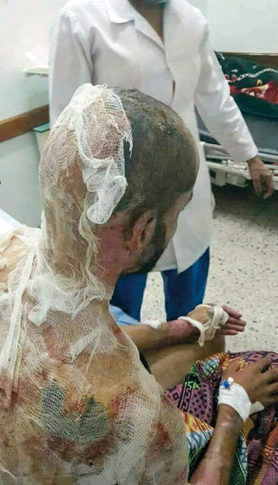 الحروق غطت الجزء العلوي من جسد المشرقي. من المصدر