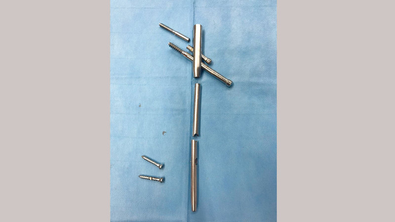 المسمار المعدني انفصل إلى 4 قطع. من المصدر