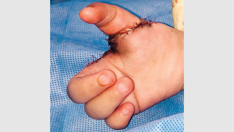 زراعة السبابة منحت يد الطفل بعداً جمالياً. من المصدر