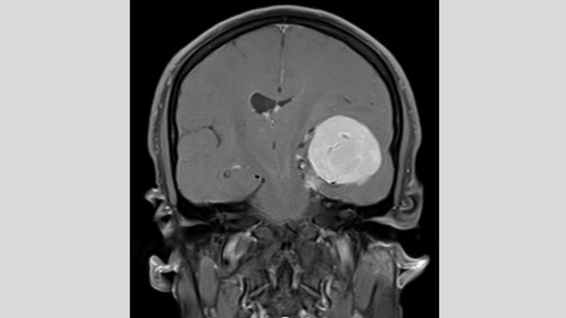 شكل وموقع الورم في رأس «مهند» قبل إجراء الجراحة. من المصدر