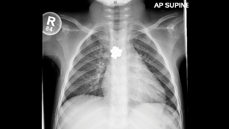 صورة الأشعة أظهرت الحلق مستقراً في الجهاز الهضمي. من المصدر