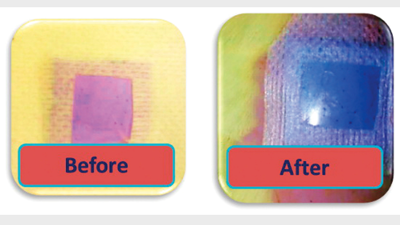 تحمل الضمادة في بداية استخدامها اللون القرمزي ثم يتغير خلال فترة الالتئام ويصل في النهاية للون ذاته  للدلالة على شفاء الجرح وتنبيه المريض إلى ضرورة إزالة الضمادة. الإمارات اليوم