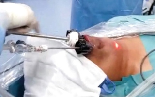 مستشفى دبي يزيل «كيساً» من حنجرة مريض