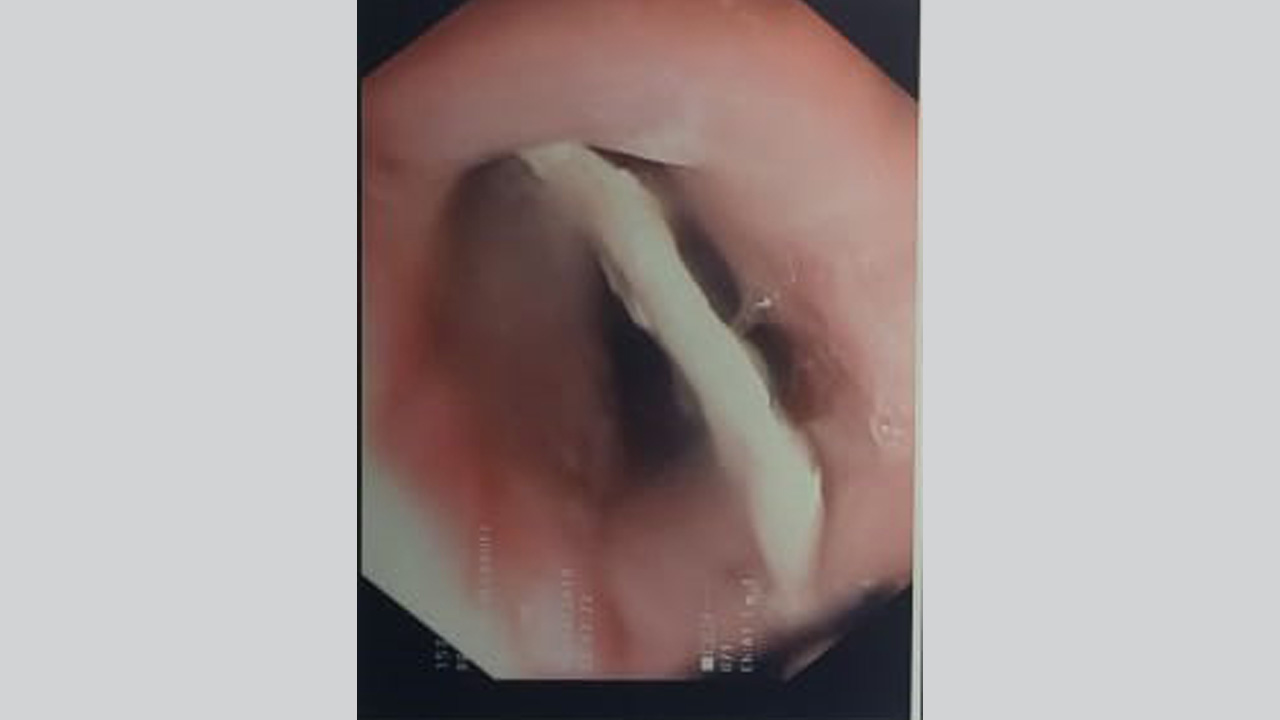 صورة ابتلاع العظمة