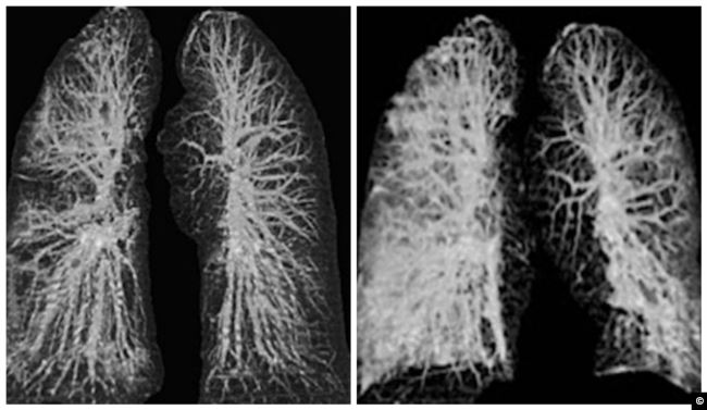 رئتي المصاب بالكورونا: على اليسار قبل الإصابة، وعلى اليمين بعد الإصابة