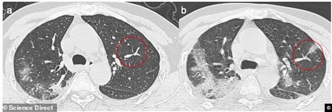 الفراغات المليئة بالدم والصديد أو الماء في رئة المصاب بالكورونا، قبل (على اليسار) وبعد (على اليمين)