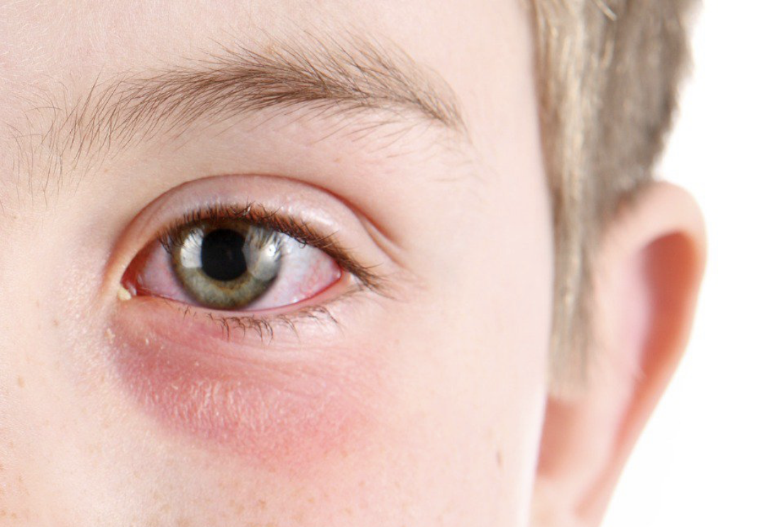 العين التهاب ملتحمة أفضل 10