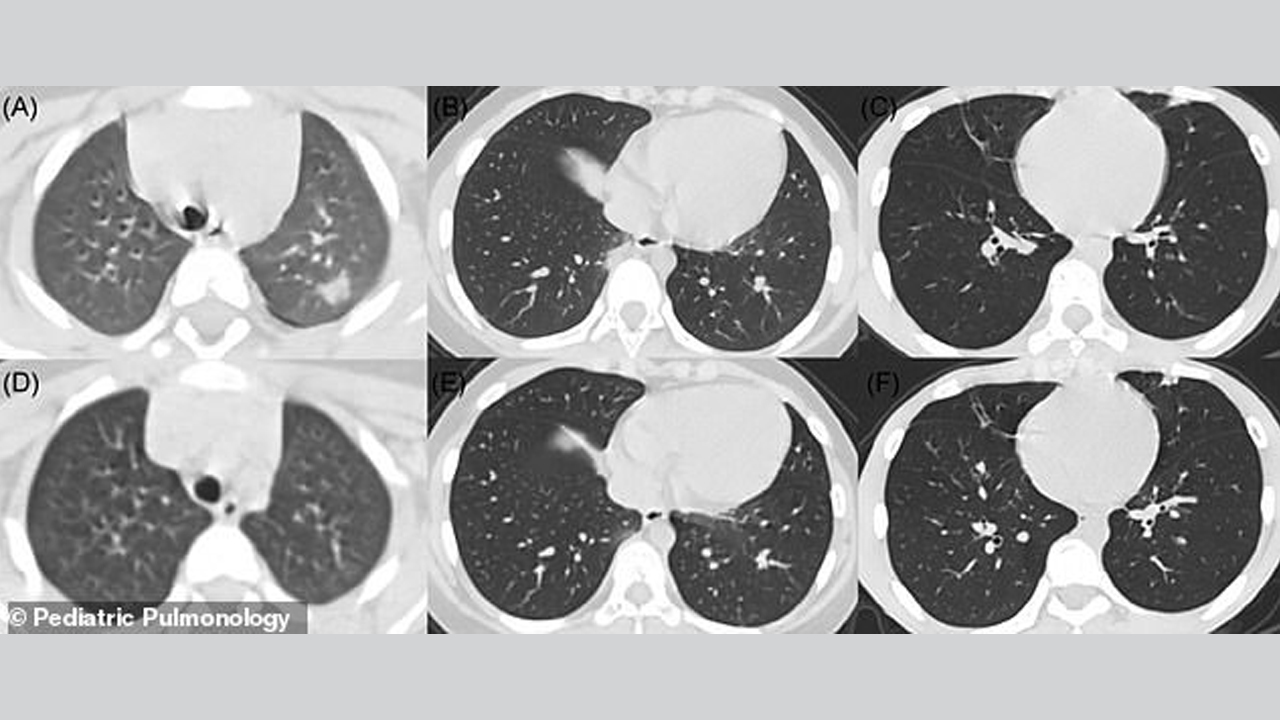 300—500 кт. кт легких. гипостатическая пневмония на кт. топография сегментов легких на кт. милиарный туберкулез кт.