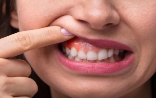 الصورة: علامات في الفم قد تشير إلى وجود 4 حالات صحية خطيرة