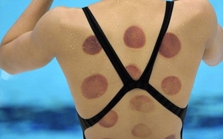 "بقع الحجامة" تغطي أجساد رياضيين في أولمبياد طوكيو.. تعرف إلى فوائدها (صور)