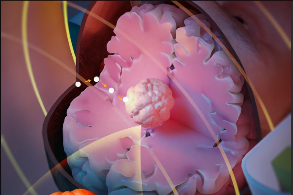 seed” will revolutionize cancer treatment Teller Report