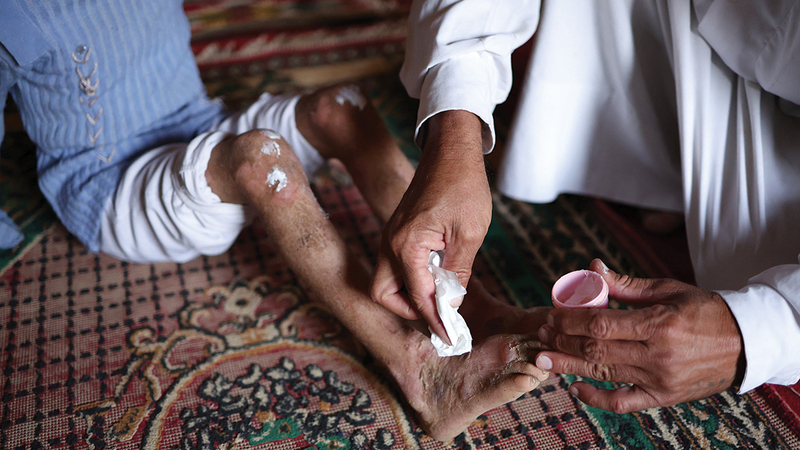 طفلة في الديوانية بالعراق تتلقى العلاج في قدمها بعد إصابتها بجروح نتيجة المياه الملوثة.   رويترز