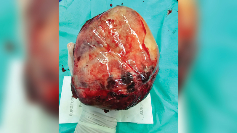 تم استئصال الورم بعملية جراحية دقيقة.  من المصدر