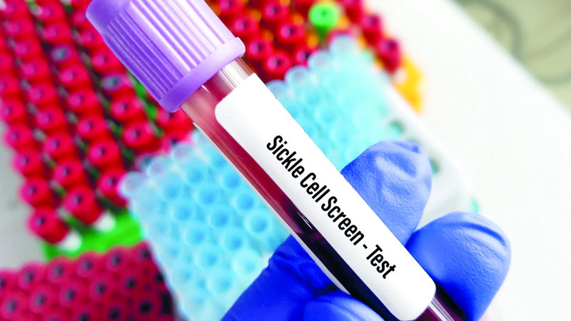 تمت إجازة عقار «كاسجيفي» لعلاج فقر الدم المنجلي. أرشيفية