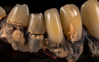 الصورة: العثور على أسنان بشرية متسوّسة عمرها 4000 عام