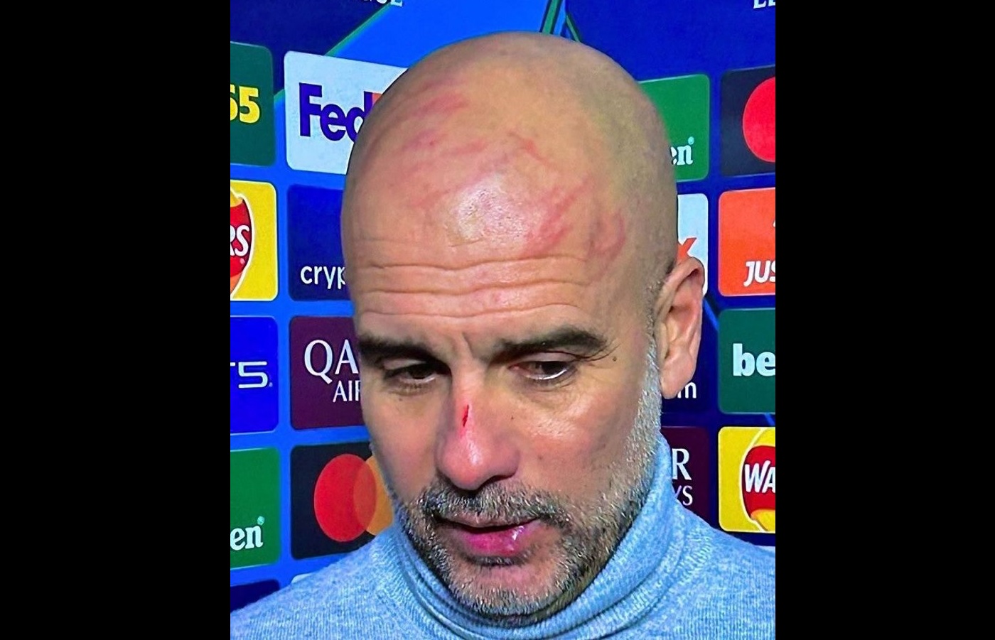 حقيقة الخدوش في وجه غوارديولا بعد نزيف مانشستر سيتي.. "أريد إيذاء نفسي"!