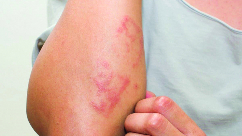 الأطباء حذّروا من تجاهل علامات جلدية قد تبدو بسيطة في ظاهرها. أرشيفية