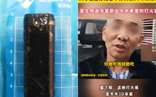 الصورة: اكتشاف ولّاعة في معدة رجل موجودة من 40 سنة .. ولا زالت صالحة للعمل