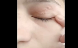 الصورة: دودة حية طولها 11 سم في عين شابة.. مصدرها لا يخطر على البال