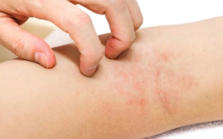 الصورة: خيار علاجي واعد للأكزيما