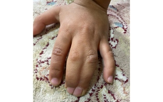 الصورة: &laquo;ساري&raquo; يحتاج إلى &laquo;جراحة عاجلة&raquo; بـ 62.6 ألف درهم لفصل أصابع اليد