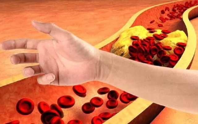 الصورة: أمور بالغة الأهمية لصحتك.. هذا كل ما تريد معرفته عن الكوليسترول الضار والمفيد والدهون الثلاثية