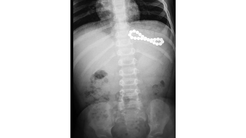 خطورة &laquo;الكرات المغناطيسية&raquo; تكمن في قوة الجذب المغناطيسي العالية لها. أرشيفية