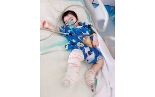 الصورة: الرضيع &laquo;شاهين&raquo; يعاني حروقاً من الدرجة الثانية.. ويحتاج 34.7 ألف درهم للعلاج