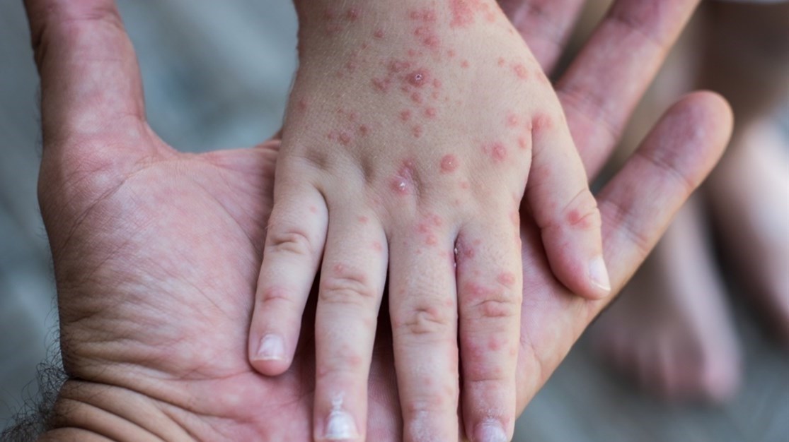 تفشي الحصبة في ولاية خاليسكو المكسيكية المشاركة في استضافة كأس العالم 2026