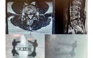 الصورة: إجراء أول عملية في الشرق الأوسط بتقنية متطورة لتثبيت فقرات الظهر