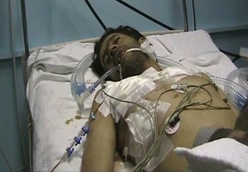 أحد المصابين في الاشتباكات بين المتظاهرين والأمن السوري يرقد في مستشفى في درعا. رويترز