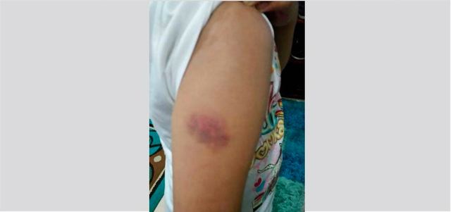 الطالبة تعرضت لاعتداء بالضرب بعصا وفق نتائج الفحص الطبي. الإمارات اليوم