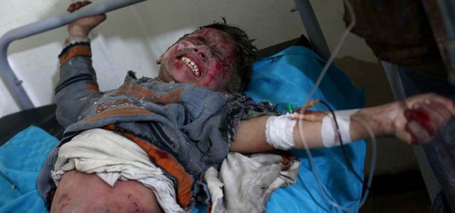 صبي سوري يتألم وهو يتلقى العلاج في مستشفى ميداني عقب إصابته بغارة للنظام السوري على مدينة دوما.  أ.ف.ب