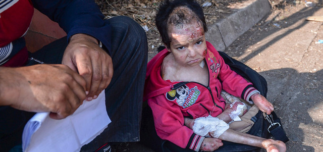 طفل سوري أصيب في حلب وهاجر يجلس داخل حقيبة في مقدونيا بانتظار القطار المتجه إلى الحدود الصربية. إي.بي.إيه