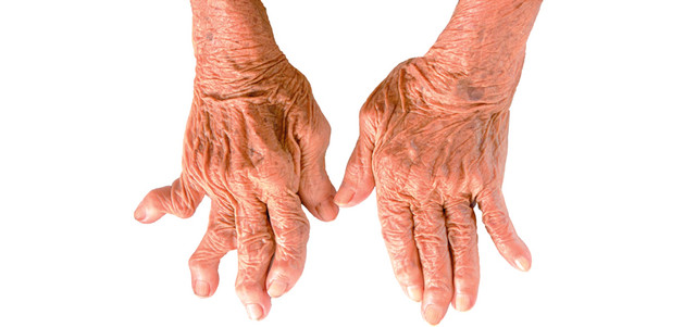 10 آلاف مواطن يعانون من التهاب المفاصل الروماتويدي محلياً صحة الإمارات اليوم