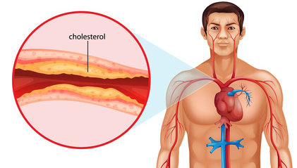 الوجبات التي تحتوي على كمية كبيرة من الكلسترول تسبب أمراضًا في .............