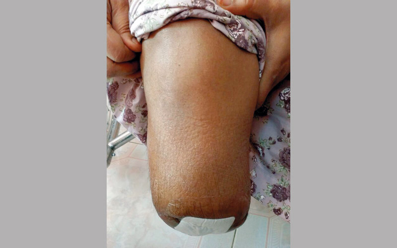 «أم محمد» أصبحت أسيرة الكرسي المتحرك منذ بتر قدمها. من المصدر