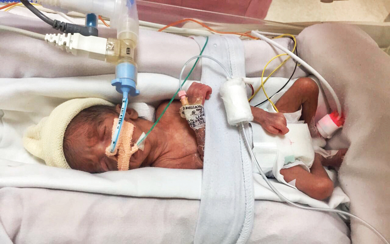 التوأمان ظلا في «الحضانة» شهرين ونصف الشهر. من المصدر