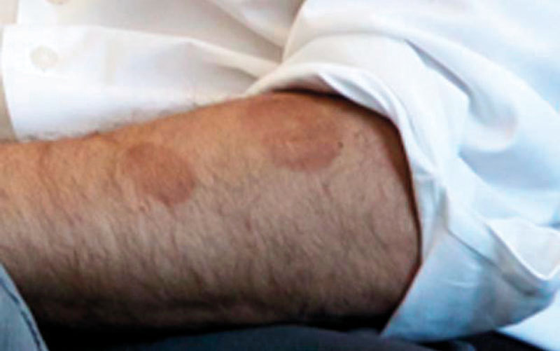 آثار الحجامة بادية على يد ترودو. أرشيفية