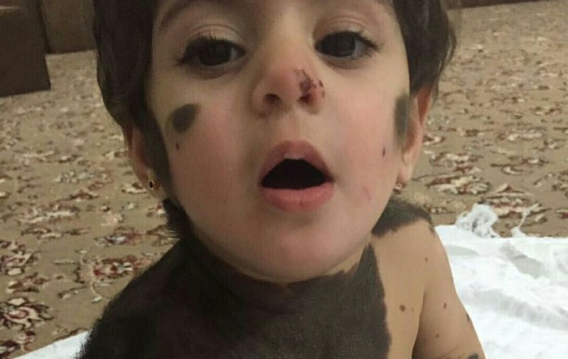 الطفلة الين قبل البدء في تنفيذ الخطة العلاجية